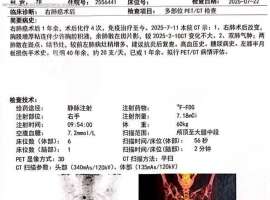 术后四化单免一年不到骨转淋巴转胸膜转